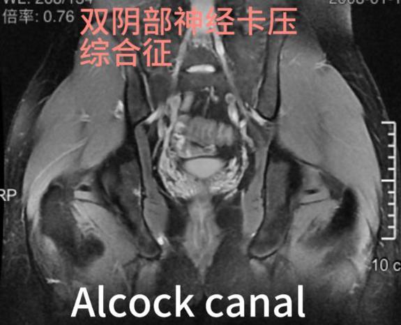 少年臀部剧痛背后：湖州邦尔骨科医院揭开被误诊的神经危机