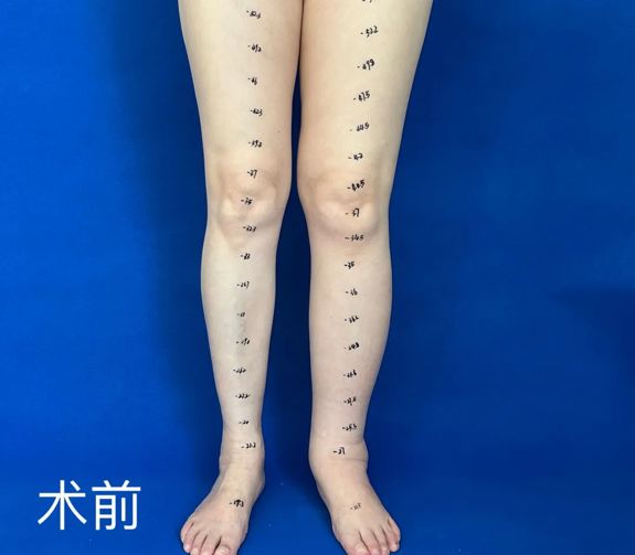 从步履蹒跚到轻盈上下楼，杭州邦尔骨科医院为淋巴水肿患者铺陈‘新生’之路